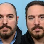 Hair Transplants For Men Performed In The UK