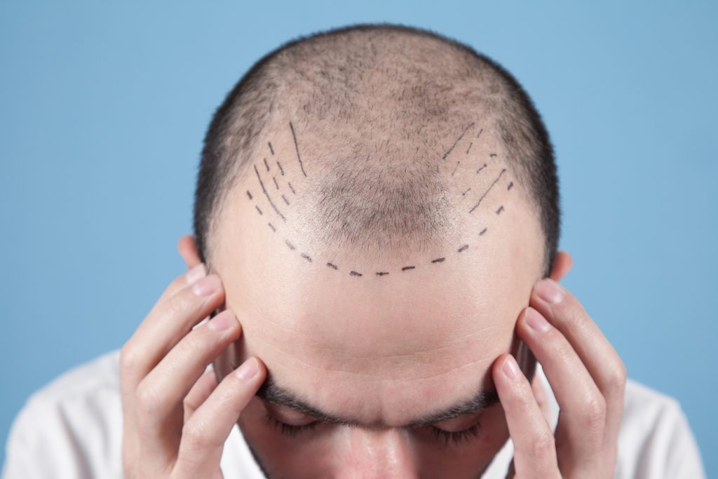 how much is hair transplant in turkey